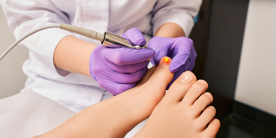 Treatment fungal infection on woman's toenail using a medical laser